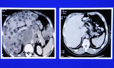 EL TABAQUISMO, RESPONSABLE DEL 30 POR CIENTO DE LOS CASOS DE CÃNCER