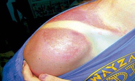 ALERTAN INVESTIGADORES DE LA UNAM POR EFECTOS DE LA RADIACIÃ“N SOLAR EN LA SALUD