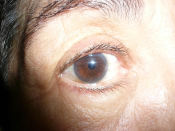 EN EL MUNDO, PADECE CATARATAS 50 POR CIENTO DE LOS ADULTOS MAYORES