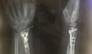 Necesario modificar factores de riesgo para evitar osteoporosis
