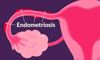 Padecimiento del útero causa dolor que puede ser incapacitante
