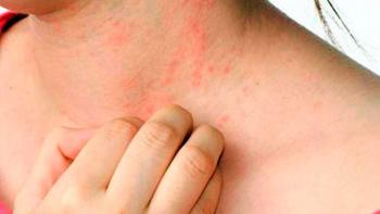 En el hígado identifican proceso que causa comezón crónica