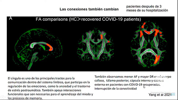 Afectaciones en el cerebro, probables secuelas por la COVID-19