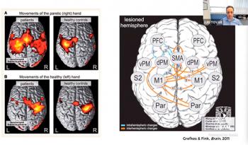 Estudian cómo un infarto cerebral modifica las conexiones neuronales