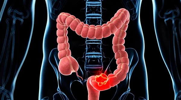 Cáncer de colon: Diagnóstico temprano y cura para una enfermedad frecuente