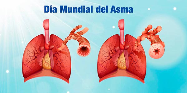 Control del Asma: Reducción en Uso de Medicamentos y Mejora en Calidad de Vida