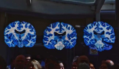 Descubre la impactante fotografía anatómica "El cerebro azul" en el INNNMVS