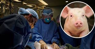 Primer paciente trasplantado con riñón de cerdo recibe el alta: un hito médico