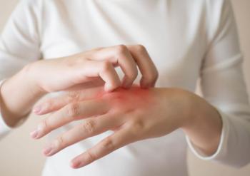 ¿Es posible ser alérgico al frío? Descubre los síntomas y cómo identificarlo