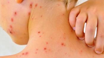 OPS alerta sobre baja vacunación en América ante brotes de sarampión y fiebre amarilla