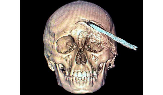 IMSS Yucatán realiza cirugía sin precedentes para extraer herramienta agrícola del cráneo de un adolescente