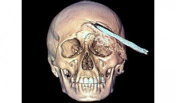 IMSS Yucatán realiza cirugía sin precedentes para extraer herramienta agrícola del cráneo de un adolescente