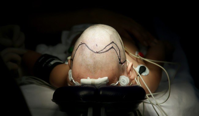 IMSS La Raza realiza primera jornada nacional de craneosinostosis en pediatría