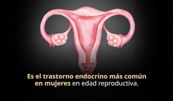 Obesidad desde la infancia aumenta riesgo de síndrome de ovario poliquístico: INSP