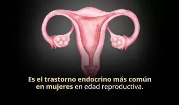 Obesidad desde la infancia aumenta riesgo de síndrome de ovario poliquístico: INSP
