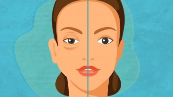 Querétaro se suma al Día Mundial del Angioedema Hereditario; llama a detección oportuna