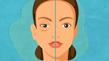 Querétaro se suma al Día Mundial del Angioedema Hereditario; llama a detección oportuna