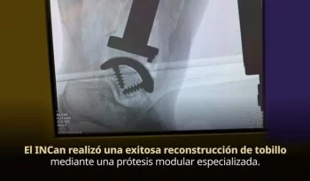 INCan salva extremidad de paciente con tumor maligno de tobillo mediante cirugía de alta especialidad