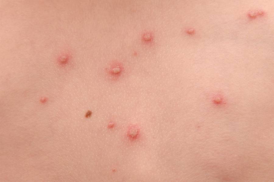 URGE PREVENIR CONTAGIO DE VIRUS DE VARICELA EN DF