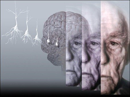En México 2 mil personas mueren al año por Alzheimer