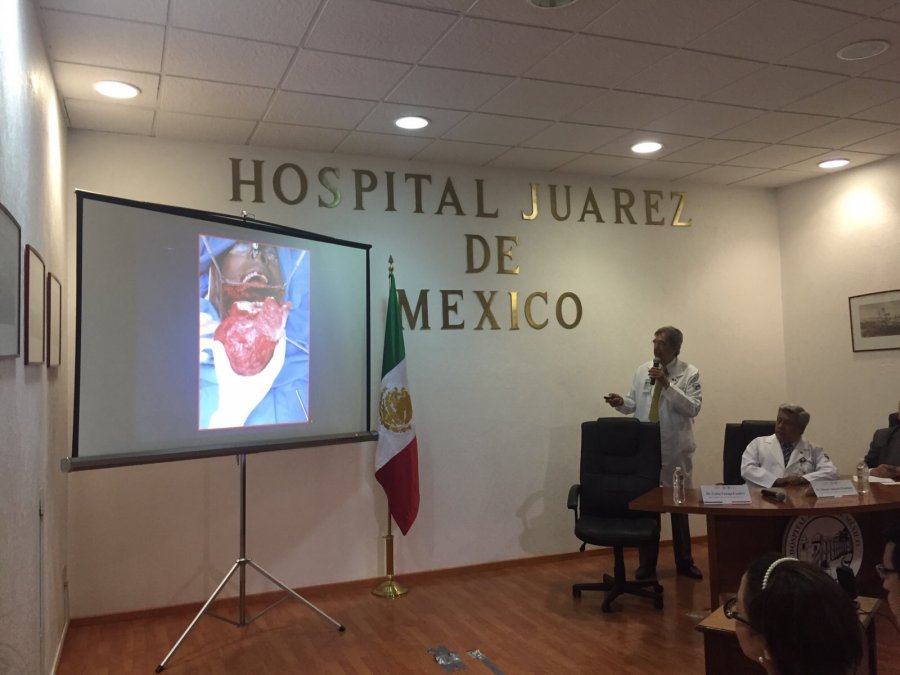 EL HOSPITAL JUÁREZ DE MÉXICO REALIZA OPERACIÓN EXITOSA DE TUMOR MANDIBULAR