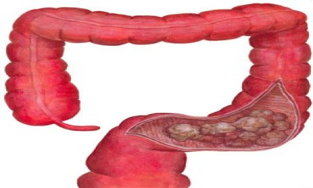 ES POSIBLE EVITAR O RETARDAR LA ENFERMEDAD DE CÃNCER COLORRECTAL